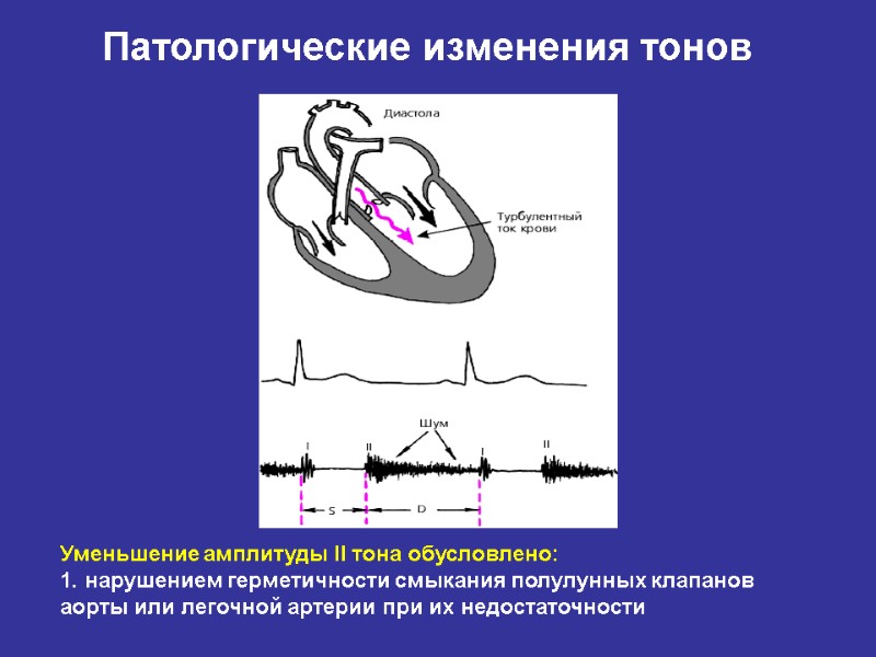 Уменьшение амплитуды II тона обусловлено:  1. нарушением герметичности смыкания полулунных клапанов аорты или